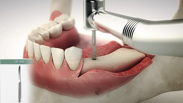 医疗三维动画：牙科手术动画
