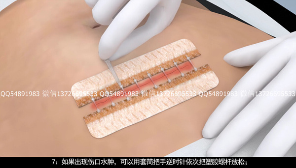 手术动画：皮肤缝合器动画