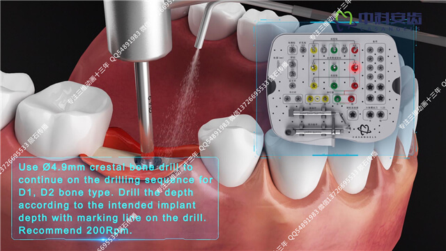 牙科种植动画